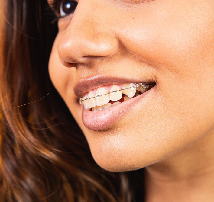 Closeup of girl smiling with tooth-colored brackets