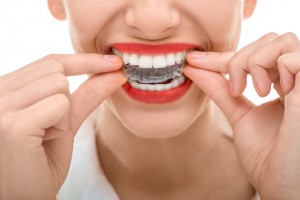 Why should I get Invisalign in Herndon?